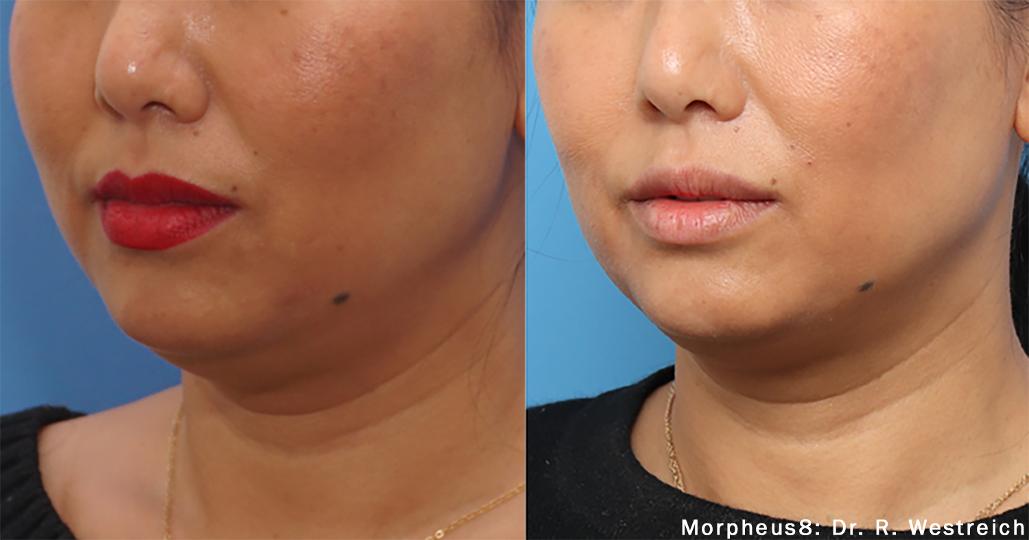 Morpheus8 RF microneedling treatment on the face